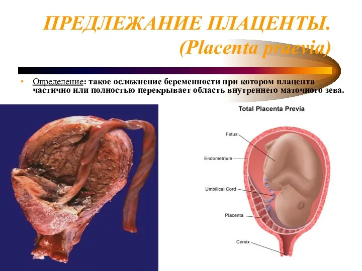 ПРЕДЛЕЖАНИЕ ПЛАЦЕНТЫ. (Placenta praevia) Определение: такое осложнение беременности при котором