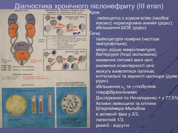 Діагностика хронічного пієлонефриту (III етап) Кров: лейкоцитоз з зсувом вліво