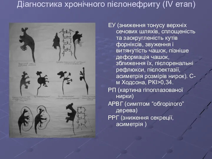 Діагностика хронічного пієлонефриту (IV етап) ЕУ (зниження тонусу верхніх сечових