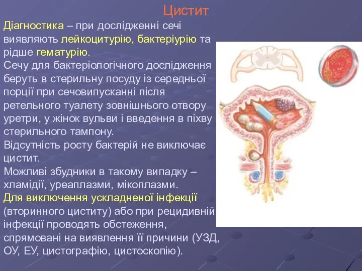 Цистит Діагностика – при дослідженні сечі виявляють лейкоцитурію, бактеріурію та