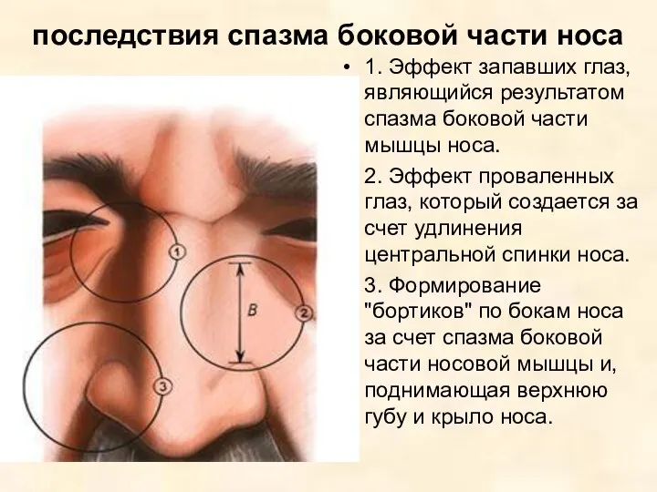 последствия спазма боковой части носа 1. Эффект запавших глаз, являющийся