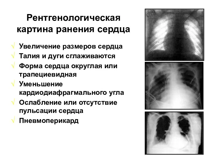 Рентгенологическая картина ранения сердца Увеличение размеров сердца Талия и дуги