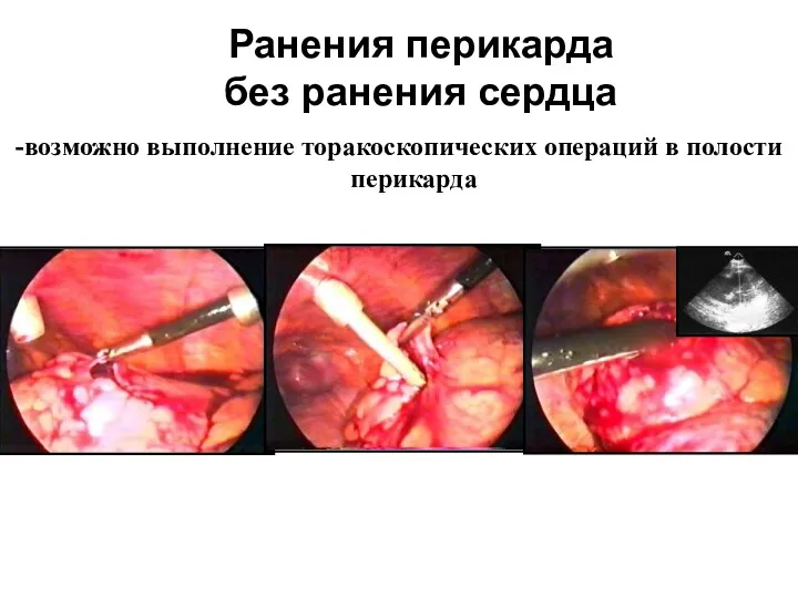 Ранения перикарда без ранения сердца -возможно выполнение торакоскопических операций в полости перикарда