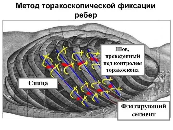 Метод торакоскопической фиксации ребер Шов, проведенный под контролем торакоскопа Флотирующий сегмент Спица