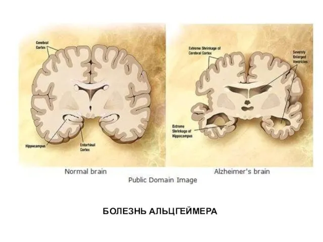 БОЛЕЗНЬ АЛЬЦГЕЙМЕРА