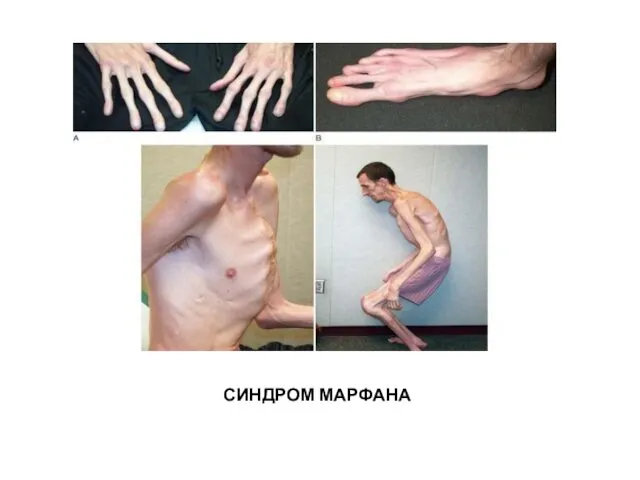 СИНДРОМ МАРФАНА