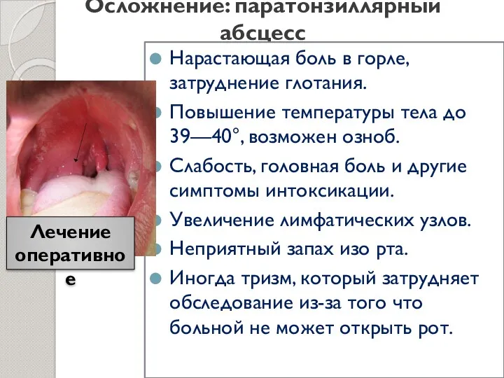 Осложнение: паратонзиллярный абсцесс Нарастающая боль в горле, затруднение глотания. Повышение