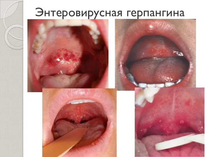 Энтеровирусная герпангина