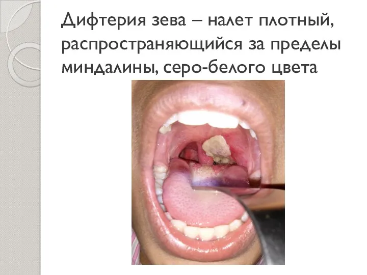 Дифтерия зева – налет плотный, распространяющийся за пределы миндалины, серо-белого цвета