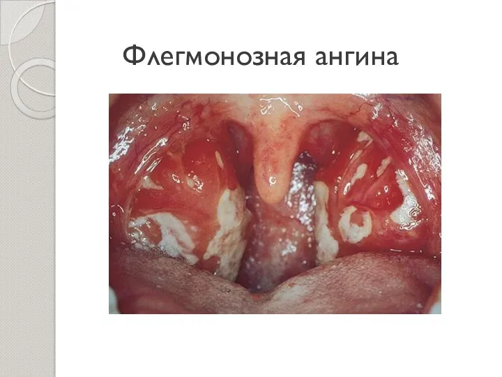 Флегмонозная ангина