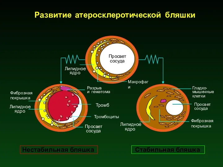 Фиброзная покрышка Липидное ядро Разрыв и гематома Тромб Тромбоциты Макрофаги