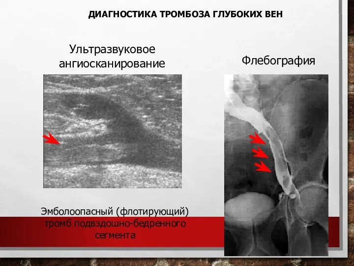 Флебография Эмболоопасный (флотирующий) тромб подвздошно-бедренного сегмента Ультразвуковое ангиосканирование ДИАГНОСТИКА ТРОМБОЗА ГЛУБОКИХ ВЕН