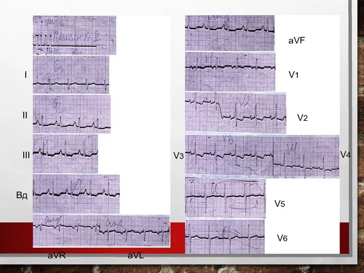 I II III Вд aVR aVL aVF V1 V2 V3 V6 V4 V5