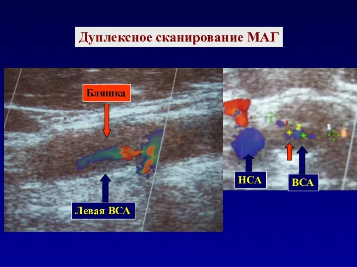 Дуплексное сканирование МАГ Левая ВСА Бляшка НСА ВСА