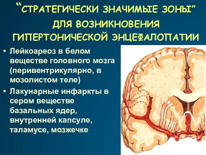 “СТРАТЕГИЧЕСКИ ЗНАЧИМЫЕ ЗОНЫ” ДЛЯ ВОЗНИКНОВЕНИЯ ГИПЕРТОНИЧЕСКОЙ ЭНЦЕФАЛОПАТИИ Лейкоареоз в белом веществе головного мозга
