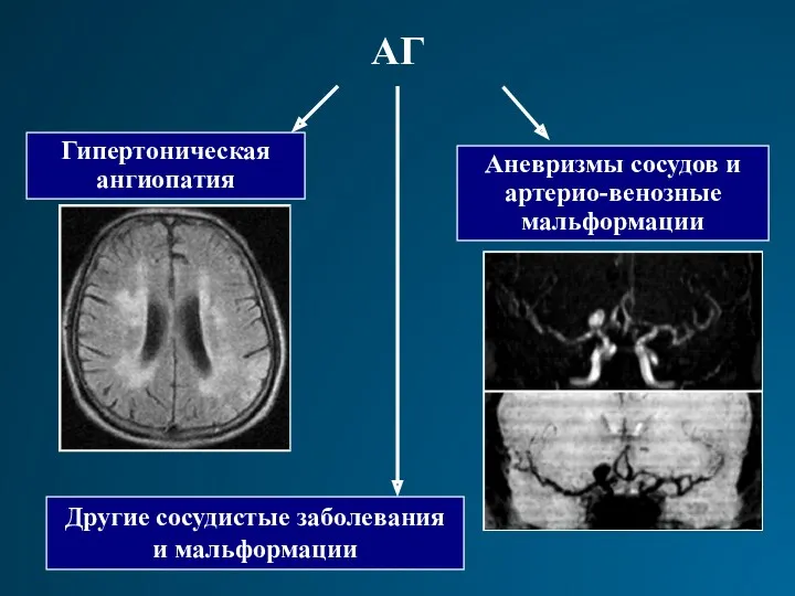 Гипертоническая ангиопатия Аневризмы сосудов и артерио-венозные мальформации Другие сосудистые заболевания и мальформации АГ