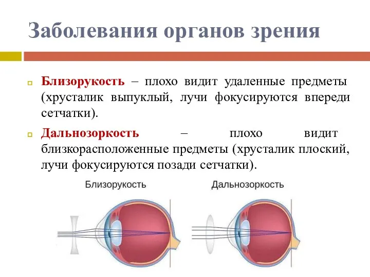 Заболевания органов зрения Близорукость – плохо видит удаленные предметы (хрусталик