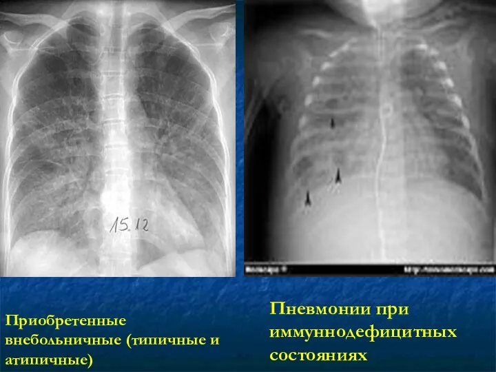 Пневмонии при иммуннодефицитных состояниях Приобретенные внебольничные (типичные и атипичные)