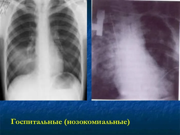 Госпитальные (нозокомиальные)