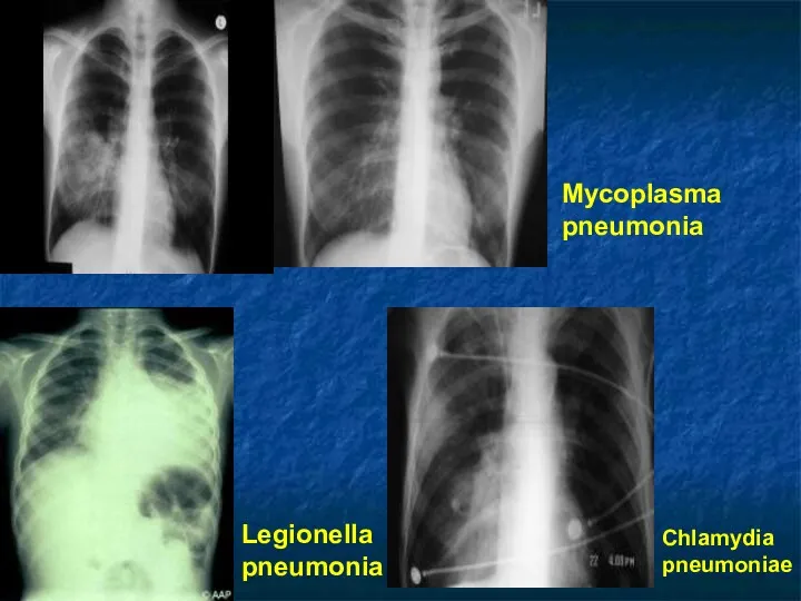 Mycoplasma pneumonia Legionella pneumonia Chlamydia pneumoniae