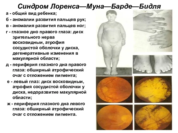 Синдром Лоренса—Муна—Барде—Бидля а - общий вид ребенка; б - аномалии