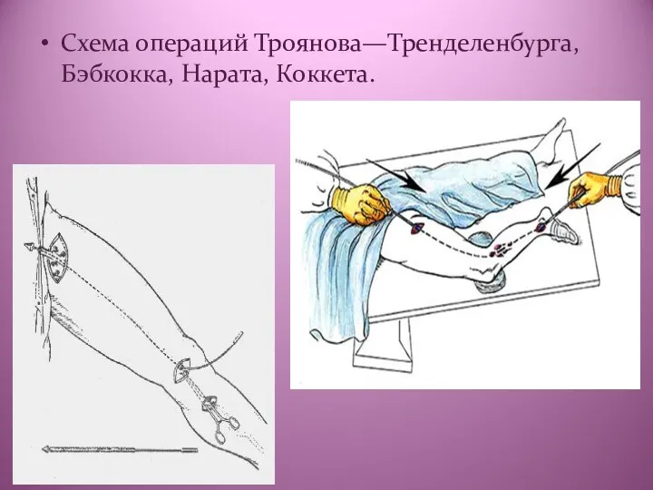 Схема операций Троянова—Тренделенбурга, Бэбкокка, Нарата, Коккета.