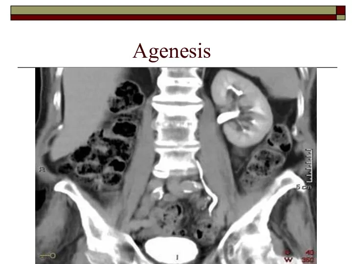 Agenesis