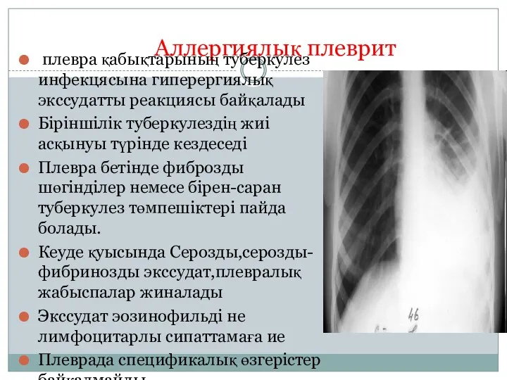 Аллергиялық плеврит плевра қабықтарының туберкулез инфекцясына гиперергиялық экссудатты реакциясы байқалады