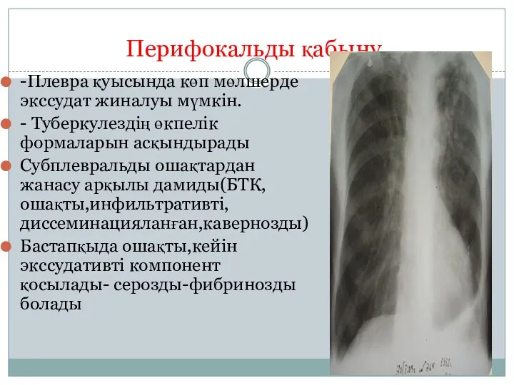 Перифокальды қабыну -Плевра қуысында көп мөлшерде экссудат жиналуы мүмкін. -