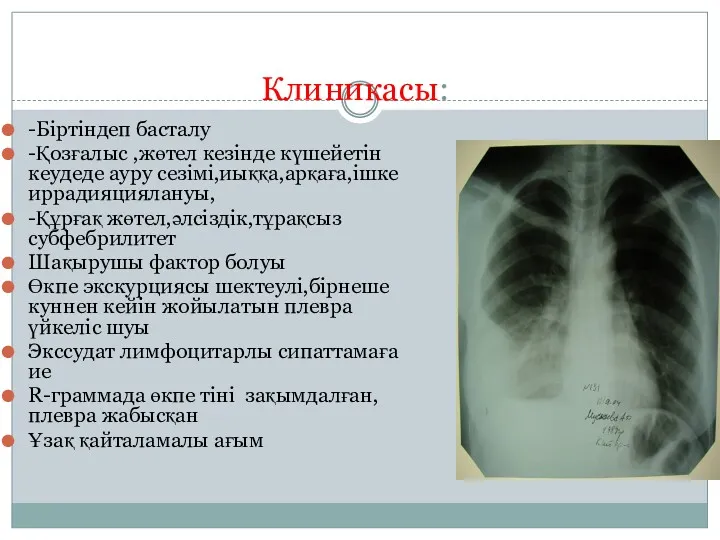 Клиникасы: -Біртіндеп басталу -Қозғалыс ,жөтел кезінде күшейетін кеудеде ауру сезімі,иыққа,арқаға,ішке