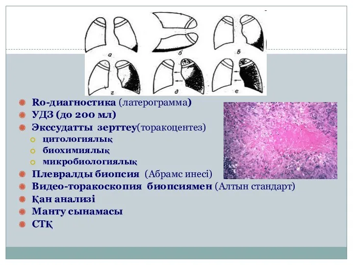 Ro-диагностика (латерограмма) УДЗ (до 200 мл) Экссудатты зерттеу(торакоцентез) цитологиялық биохимиялық