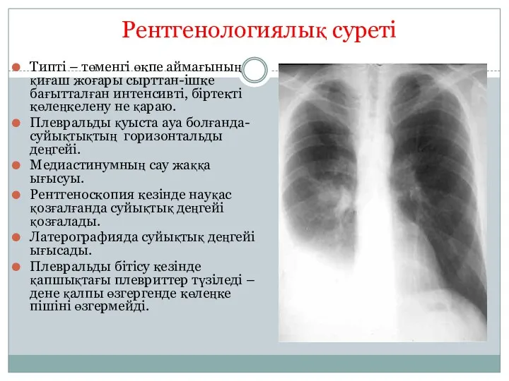 Рентгенологиялық суреті Типті – төменгі өкпе аймағының қиғаш жоғары сырттан-ішке