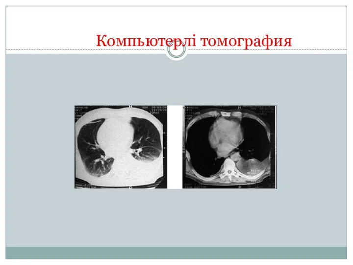 Компьютерлі томография