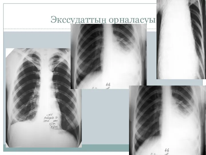 Экссудаттың орналасуы