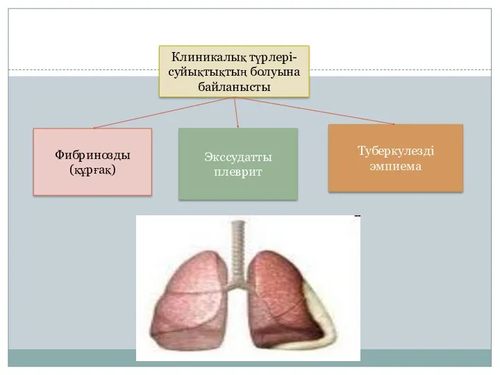 Клиникалық түрлері-суйықтықтың болуына байланысты Фибринозды (құрғақ) Туберкулезді эмпиема Экссудатты плеврит