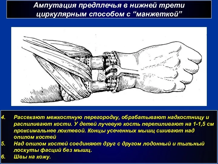 Ампутация предплечья в нижней трети циркулярным способом с “манжеткой” г