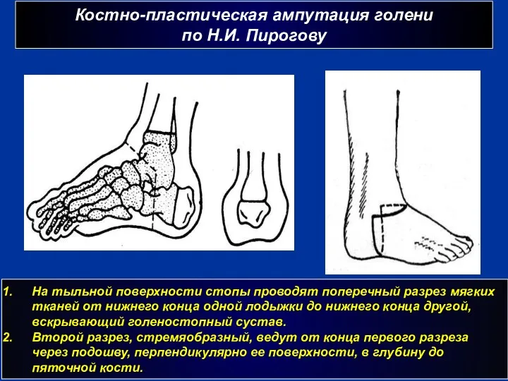 Костно-пластическая ампутация голени по Н.И. Пирогову г На тыльной поверхности