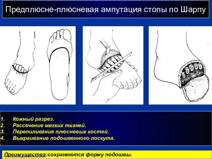 Предплюсне-плюсневая ампутация стопы по Шарпу г Кожный разрез. Рассечение мягких