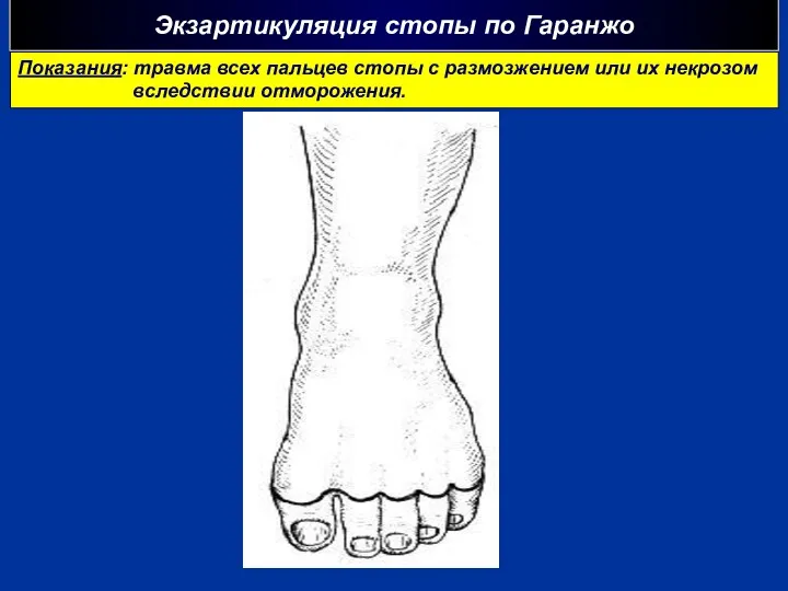Экзартикуляция стопы по Гаранжо Показания: травма всех пальцев стопы с размозжением или их некрозом вследствии отморожения.