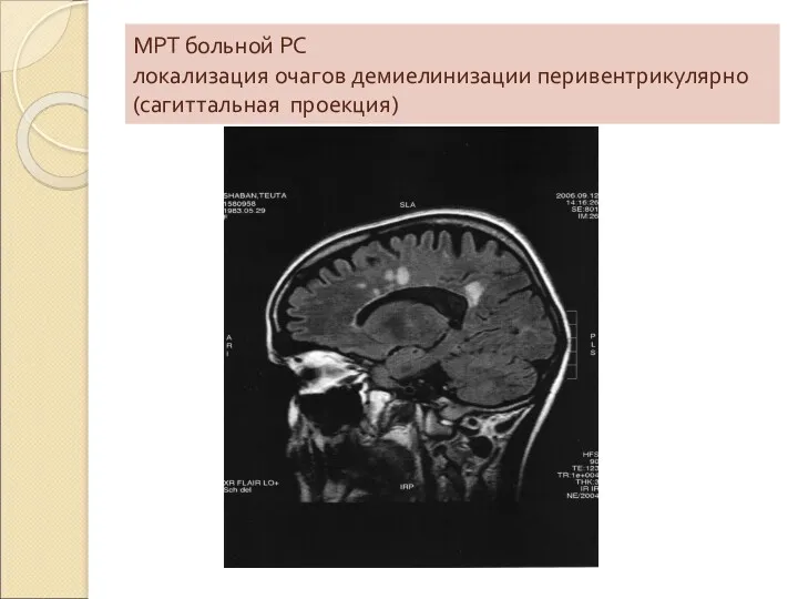 МРТ больной РС локализация очагов демиелинизации перивентрикулярно (сагиттальная проекция)