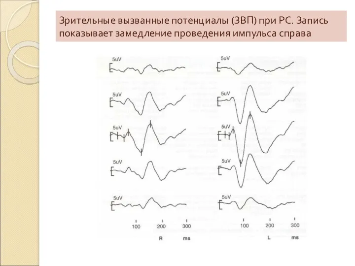 Зрительные вызванные потенциалы (ЗВП) при РС. Запись показывает замедление проведения импульса справа