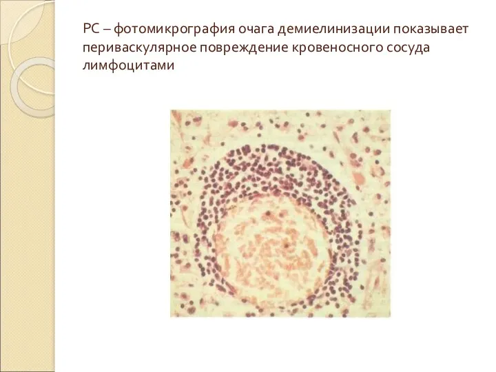 РС – фотомикрография очага демиелинизации показывает периваскулярное повреждение кровеносного сосуда лимфоцитами