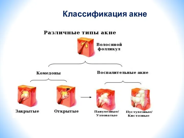 Классификация акне