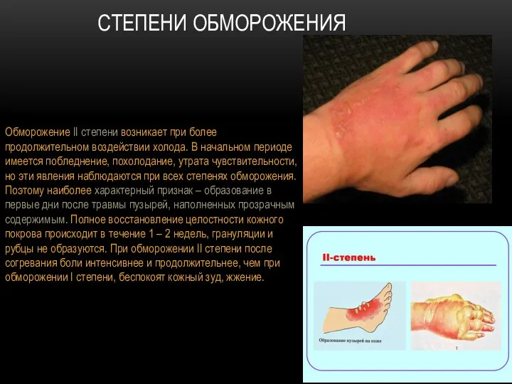 СТЕПЕНИ ОБМОРОЖЕНИЯ Обморожение II степени возникает при более продолжительном воздействии