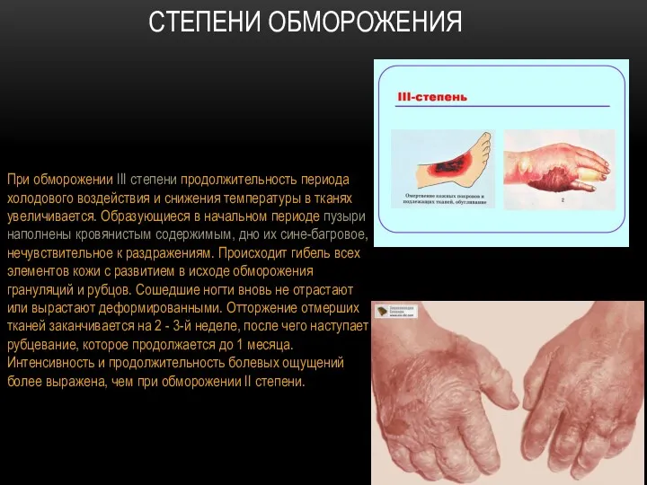 СТЕПЕНИ ОБМОРОЖЕНИЯ При обморожении III степени продолжительность периода холодового воздействия