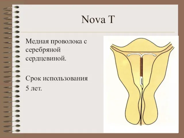 Nova T Медная проволока с серебряной сердцевиной. Срок использования 5 лет.