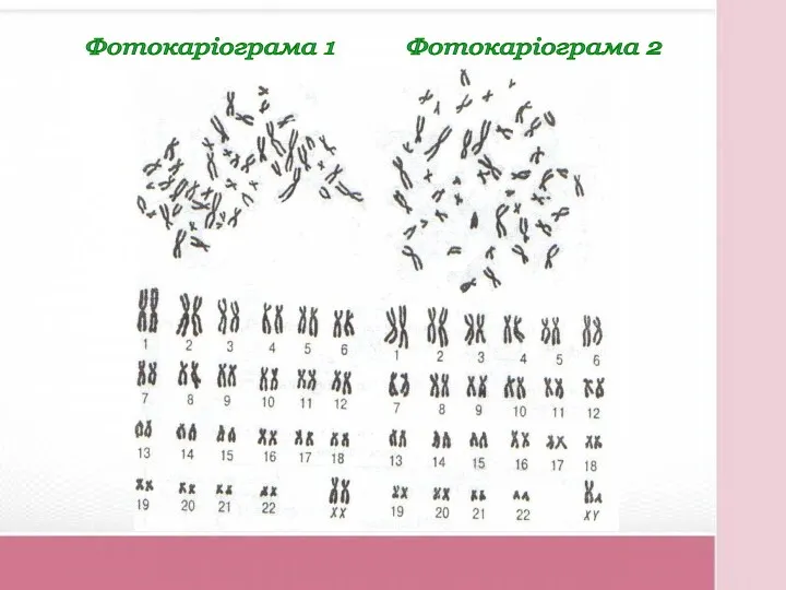 Фотокаріограма 1 Фотокаріограма 2