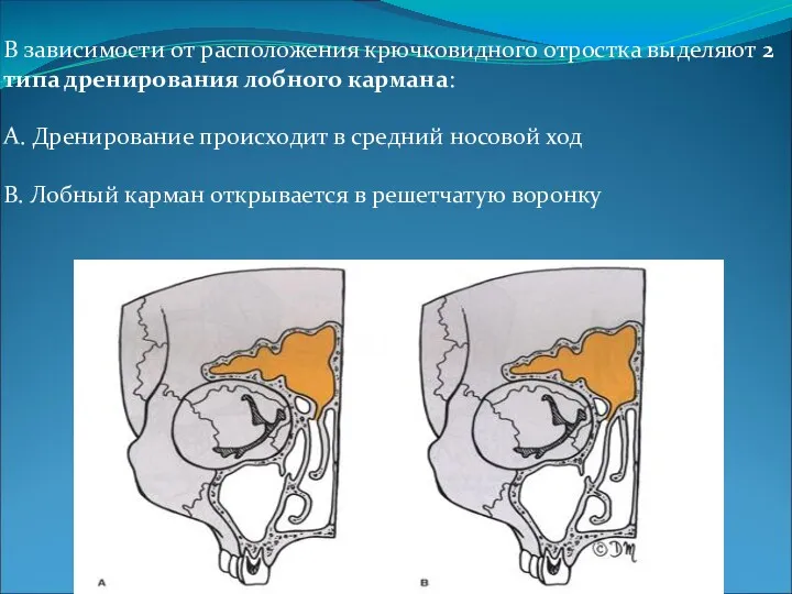 В зависимости от расположения крючковидного отростка выделяют 2 типа дренирования