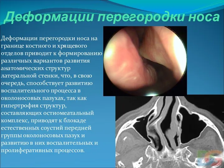 Деформации перегородки носа Деформации перегородки носа на границе костного и