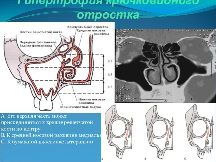 Гипертрофия крючковидного отростка A. Его верхняя часть может присоединяться к